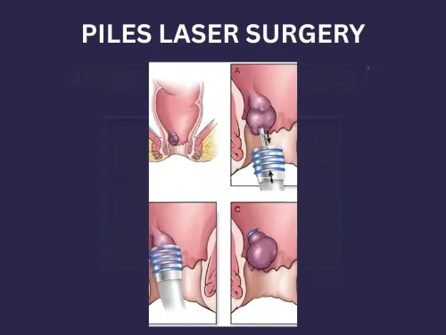 PILES LASER SURGERY service image