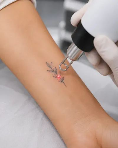 TATTOO REMOVAL service image