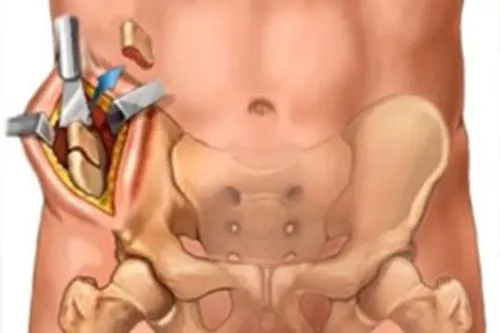 Bone Grafting and Reconstruction in Complex Joint Replacement service image
