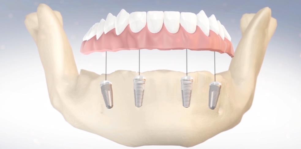 Dental Implants