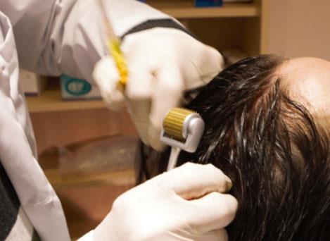 Dermaroller Therapy service image