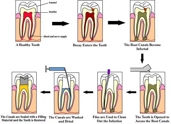 Root canal therapy is a treatm