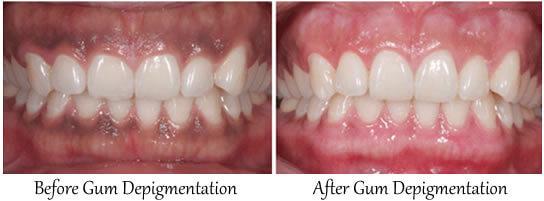 Gum depigmentation, 