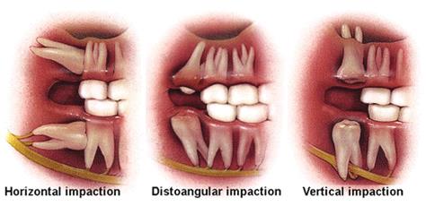 Wisdom teeth (not associated w