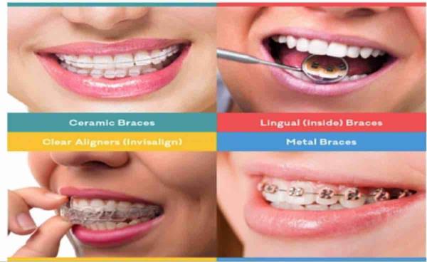 Braces