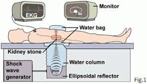 Lithotripsy uses sou