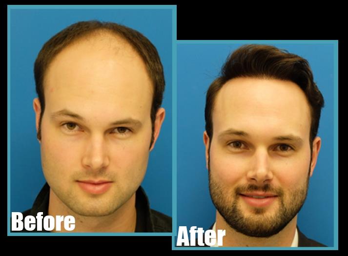 Silicon Hair Bonding