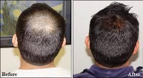 Hair Filling + Cutting