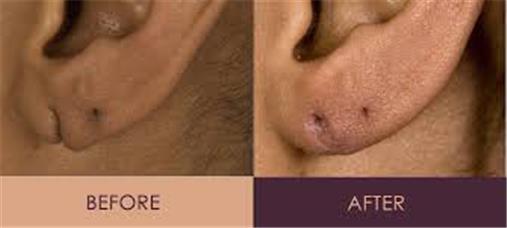 Ear Lobes Treatment product image