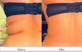Injection Lipolysis Treatment product image