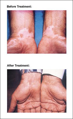 Melanocyte Transplantation product image