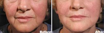 Mesoglow Treatment product image