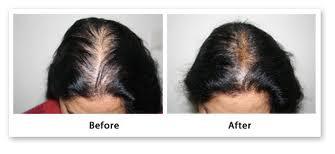 Meso Stem Cell Hair Root Therapy (MHRT) product image