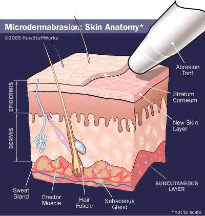 Microdermabrasion Treatment product image
