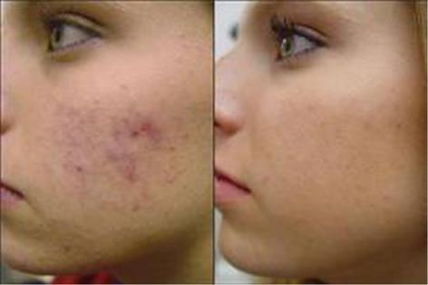 Peeling Treatment product image