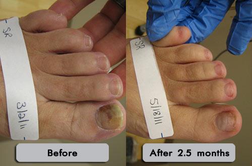 Surgical Nail Removal for Fungal Nail Infections product image
