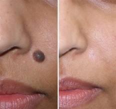 Warts, Moles & Skin Tag Removal product image