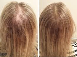 Female Hair Loss service image