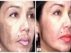 Pigmentation Treatment  service image