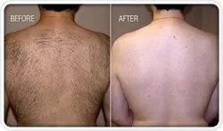  Laser Hair Removal Back Treatments service image