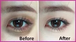 Anti Dark Circle Treatment service image