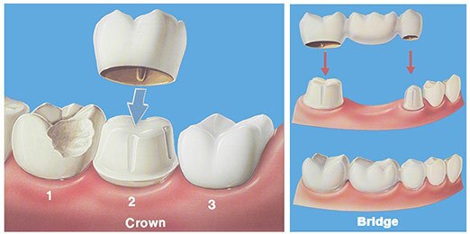 CROWNS AND BRIDGES