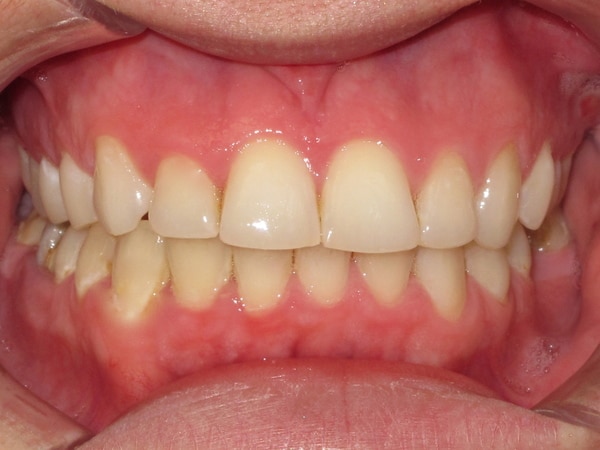Intraoral Swellings
