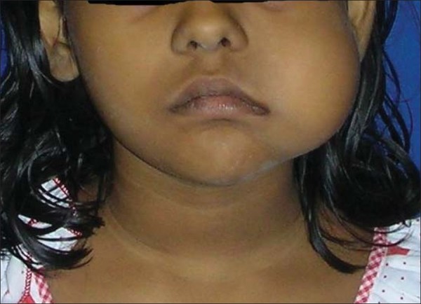 Extraoral swellings