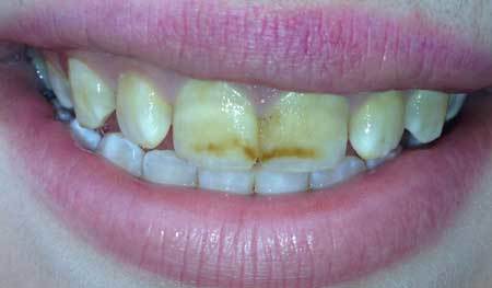 Discoloured Teeth
