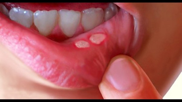 Ulcer