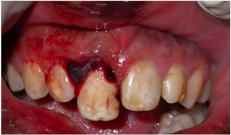 Dental Trauma