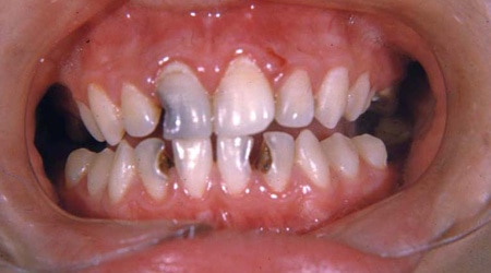 Decay of permanent T