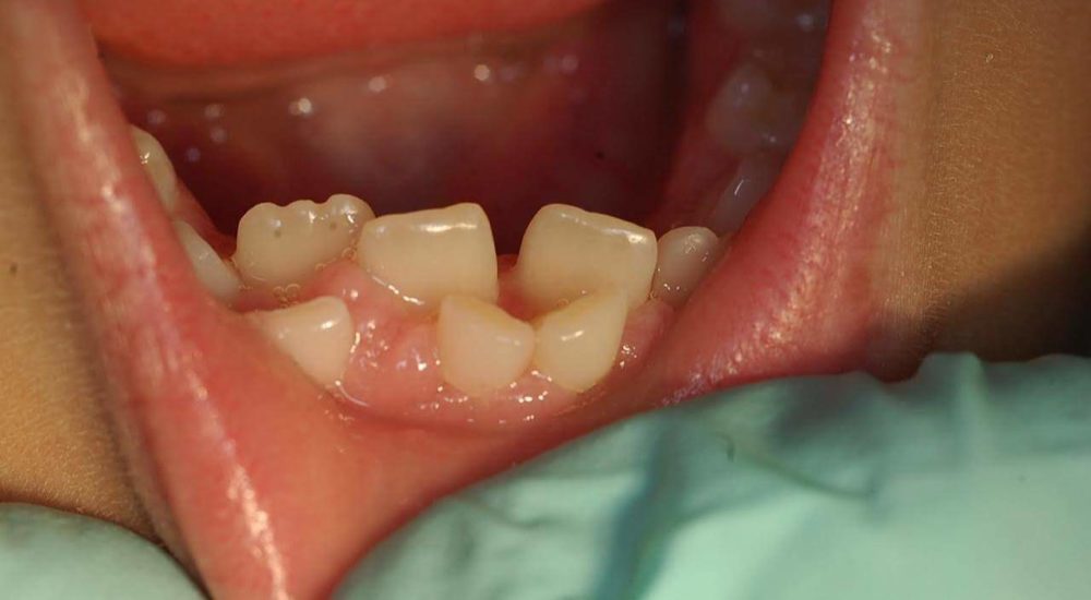 Double Extra Teeth