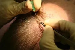  FUE HAIR TRANSPLANTATION  service image