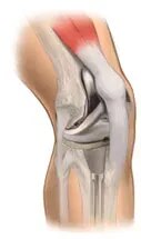 Joint Replacement & ortho product image