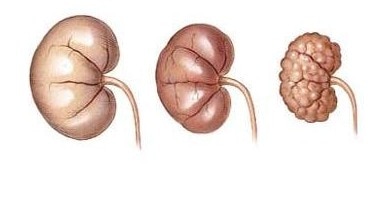 kidney fai