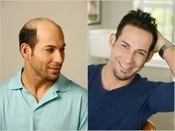 Hair Weaving for Men product image