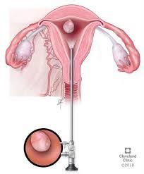 Hysteroscopy is a procedure th