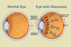  Glaucoma is often c