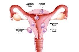 Fibroids are abnormal growths 