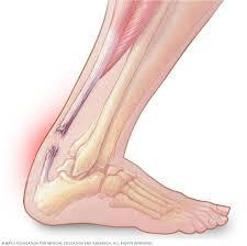 Achilles Tendon Injuries Treatment service image