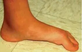 Congenital foot anomaly like club foot,vertical talus,Hemimelia service image
