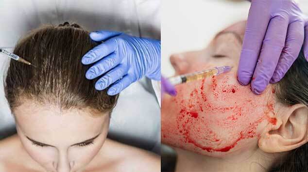 PRP Therapy product image