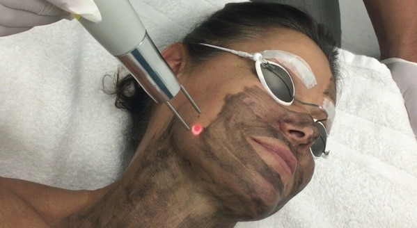 Laser Peel Treatment product image