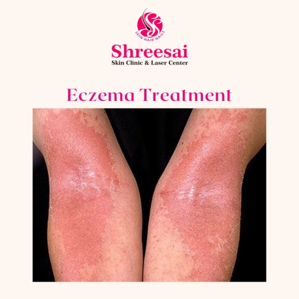 Eczema, also called atopic der