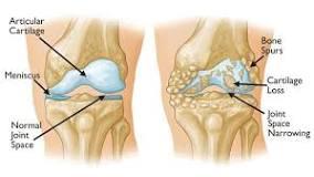 Arthritis is a disease that affects your joints (areas where your bones meet and move). Arthritis usually involves inflammation or degeneration (breakdown) of your joints. These changes can cause pain when you use the joint. Arthritis is most common in the following areas of the body