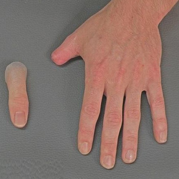 Product Overview:A Silicone Thumb Prosthesis is an advanced, custom-made solution for individuals who have lost a thumb due to trauma, congenital conditions, or surgical amputation. The prosthesis is designed to provide both aesthetic restoration and functional support, enabling the user to regain functionality in everyday tasks. Crafted from high-quality silicone, the thumb prosthesis offers a natural appearance, exceptional comfort, and durability. At Orthotech Appliances, we provide personalized solutions that help you restore the appearance and functionality of your thumb, allowing you to confidently perform daily activities.Key Features:Natural Appearance:The silicone thumb prosthesis is designed with detailed attention to anatomy, ensuring that it mimics the natural look of a thumb. It closely matches skin tone, texture, and shape, providing a realistic and aesthetically pleasing appearance.Custom-Fit Design:Each silicone thumb prosthesis is tailored to fit your residual limb perfectly. Customization ensures a comfortable fit, optimal mobility, and a prosthesis that functions well with your specific hand structure.Enhanced Functionality:While primarily a cosmetic solution, the silicone thumb prosthesis provides the user with enhanced grip and functional support for tasks such as typing, writing, or holding objects. It helps improve the overall hand function, especially when combined with the remaining digits.Lightweight & Comfortable:Made from lightweight, flexible silicone, the thumb prosthesis is comfortable for daily use. It offers a soft, skin-friendly material that reduces irritation and ensures long-lasting comfort throughout the day.Durability & Long-Lasting:Silicone is a highly durable and resilient material, ensuring that the thumb prosthesis can withstand regular use. It retains its form, appearance, and function over time with minimal maintenance.Discreet & Easy to Wear:The prosthesis is designed to be discreet, seamlessly blending with the natural hand. Its lightweight design ensures it doesn’t interfere with everyday activities, allowing for a functional yet non-intrusive solution.Indications:Thumb Amputation or Limb Loss: Ideal for individuals who have lost a thumb due to injury, disease, or congenital conditions, providing both functional and aesthetic restoration.Cosmetic Restoration: Provides a cosmetic solution for thumb loss, restoring the appearance of the hand and improving self-esteem.Functional Assistance: While not intended for heavy-duty use, the silicone thumb prosthesis offers functionality for basic tasks such as holding objects, typing, and performing other fine motor activities.Post-Surgical Recovery: Helps individuals recovering from thumb amputation or reconstructive surgery, providing both appearance restoration and comfort during the healing process.Why Choose Orthotech Appliances?Expert Design & Customization: At Orthotech Appliances, we specialize in crafting personalized silicone prosthetics. Our team works with you to ensure the thumb prosthesis is perfectly fitted and customized to your needs.High-Quality Silicone Materials: We use only the highest-quality silicone materials to ensure a prosthesis that is comfortable, durable, and realistic, enhancing both function and appearance.Personalized Care: Our team provides individual consultations to discuss your needs and ensure the best possible solution, whether for cosmetic restoration or functional support.Convenient Location: Visit us at Laxmi Nagar, East Delhi, where our experts are available to help you with custom fittings and guide you through the process.Visit Us Today!If you’ve lost your thumb due to injury or medical reasons, visit Orthotech Appliances in Laxmi Nagar, East Delhi, to explore the benefits of a Silicone Thumb Prosthesis. Our expert team will work with you to design a prosthetic that offers both aesthetic appeal and practical support.For inquiries or more information, please contact us at:Phone Number: [Insert Contact Number]Email: [Insert Email Address]Restore your confidence and functionality with a Silicone Thumb Prosthesis from Orthotech Appliances!