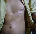 Vitiligo Types