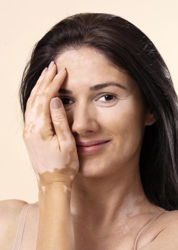 Healing patches by eliminating root causeCauses Of VitiligoThe precise cause of Vitiligo is complex and not fully understood. There are several theories regarding the cause of Vitiligo. According to one theory people with Vitiligo develop antibodies that turn upon them and destroy their own melanocytes instead of protecting them. There is another theory according to which the melanocytes somehow attack and destroy themselves.According to Modern view there are some factors responsible for Vitiligo:Autoimmune related:- a condition whereby the immune system of body destroys its own tissues and cells. Some diseases like hyperthyroidism, perinicious anaemia, alopecia areata are related to Vitiligo.Genetic cause:-It is 30% heriditary. Generally it passes on third generation.Hormonal cause :-Some hormones are responsible for Vitiligo like melanocyte stimulating hormone, thyroid hormone.Vitamin B12 and Vitamin D deficiency.Impaired liver function as jaundice, gastric disorder, typhoid fever.Excessive use of antibiotics or medicine.Pressure or friction of tight clothes, undergarments, etcExcessive sun exposure or exposed with industrial chemicals.According to AyurvedaIn Ayurveda, Vitiligo is known as ‘SHWITRA’ or ‘KILASA’ – the appearance of a patch on skin with white coloration.In Ayurveda we believe that there is a great role of diet in the causative factor and also treatment of this problem. In Ayurveda it has been said that certain food articles are never to be mixed while eating that can cause harmful effect to your body, thus said to be ‘Viruddha-Ahar’ . Viruddha-Ahar meaning opposite food combination. For instance fish and milk, milk and salt, milk and banana, milk with sour fruits, milk with yogurt. These are opposite food combinations which taken together can produce slow poison in our body.Stressful event disturbs your Manovoha strotas (Mental state) and due to that mechanism, Annavaha strotas (Digestive System) is altered resulting into forming toxins. It can trigger Vitiligo.