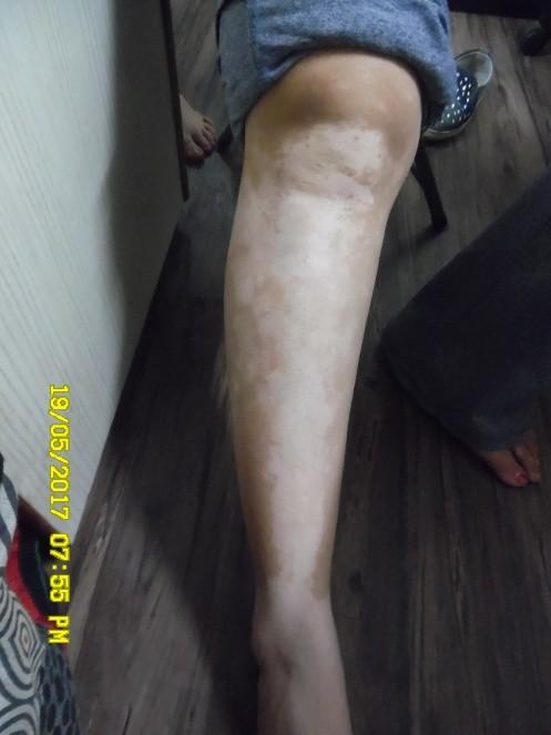 What is Vitiligo?Vitiligo is a condition in which the pigments are lost from areas of the skin, causing whitish patches on the skin. It is due to abnormality of melanin producing cells called melanocytes (special skin producing colour pigments).The white patches often change shape , shrink or grow. They may even remain constant throughout the life. The extent and rate of colour loss from Vitiligo is unpredictable but it usually appears on sun-exposed area, such as hands, feet, arms, face and lips. It can affect any skin type or any part of the body including hair as well as the tissues (mucous membranes) that lines the inside part of the mouth, nose, genital and rectal area and the retina of the eyes.It is non contagious disorder and does not affect any internal organs of the body but having a great social stigma and is stressful for the patients.Generally it affects 1 to 1.5% of the world population. But in India it is around 1.5 to 2% of population. Vitiligo affects all races and both sexes equally and maximum cases below the age of 40.Important Message:The most important thing is to start the treatment by the specialized doctor as soon as one notices the first patch.If Ayurvedic treatment is started at this initial stage by an expert doctor then it can arrest further spread, gets cured and generally doesn’t relapses.It is observed that patient gets misguided by general doctors who gives temporary suppressing treatment including steroids which disturbs the internal mechanism of body and in due course of time the disease flares up making it difficult to treat.It is advised to the patients that they should stick to one pathy at a time. One should not try two pathies for same disease like Allopathy and Ayurveda, Homeopathy etc as it may interact with each other and can complicate the disease.